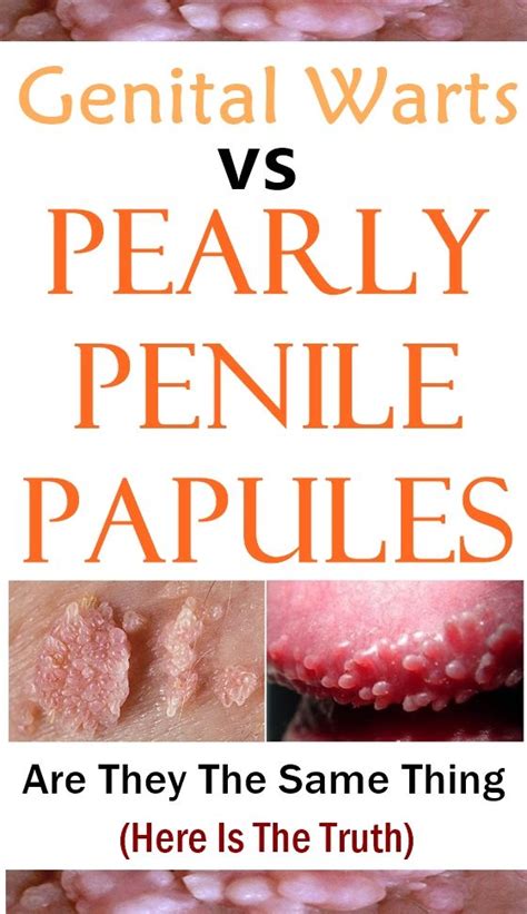 papule penienne|Penile Papules: What Are They and How Do They。